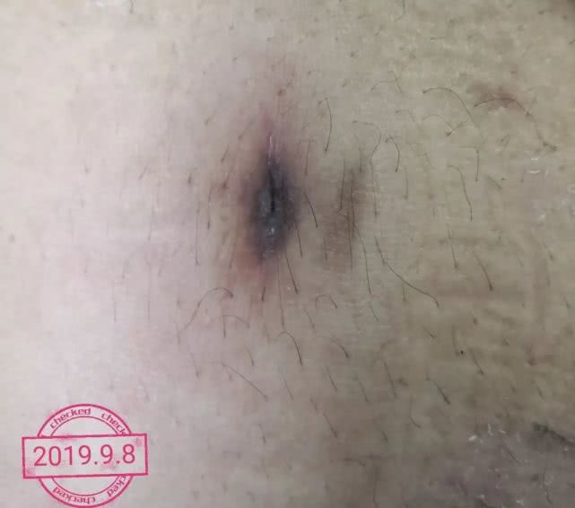 阑尾炎形成窦道的原因,阑尾炎一孔微创手术全过程