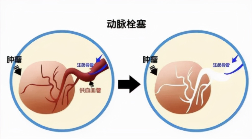 肿瘤介入微创疗法要多少钱,微创治疗肿瘤有哪些手段