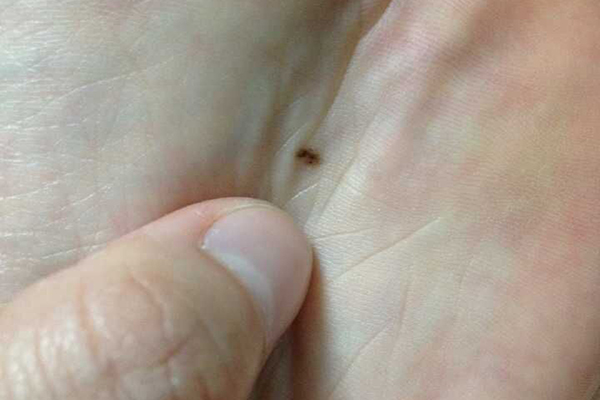 人身体上的痣有哪些忌宜,痣有好痣和坏痣的说法吗