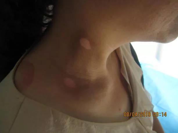 从确诊到康复,仅4个月,颈部白癜风患者王女士分享成功经验