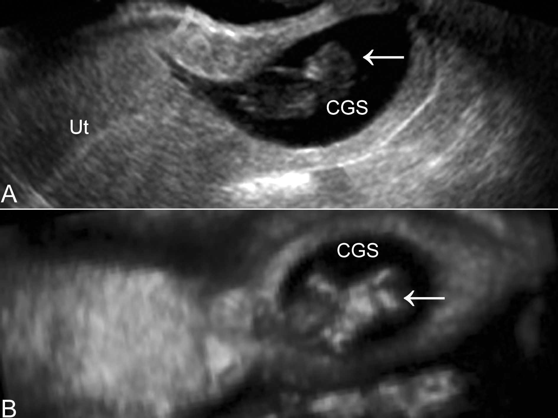 宫颈妊娠的超声表现,超声诊断出来宫颈妊娠吗