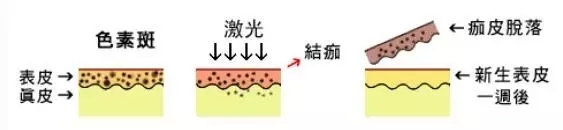 色斑雀斑晒斑的图片,晒斑雀斑淡斑最简单有效的方法