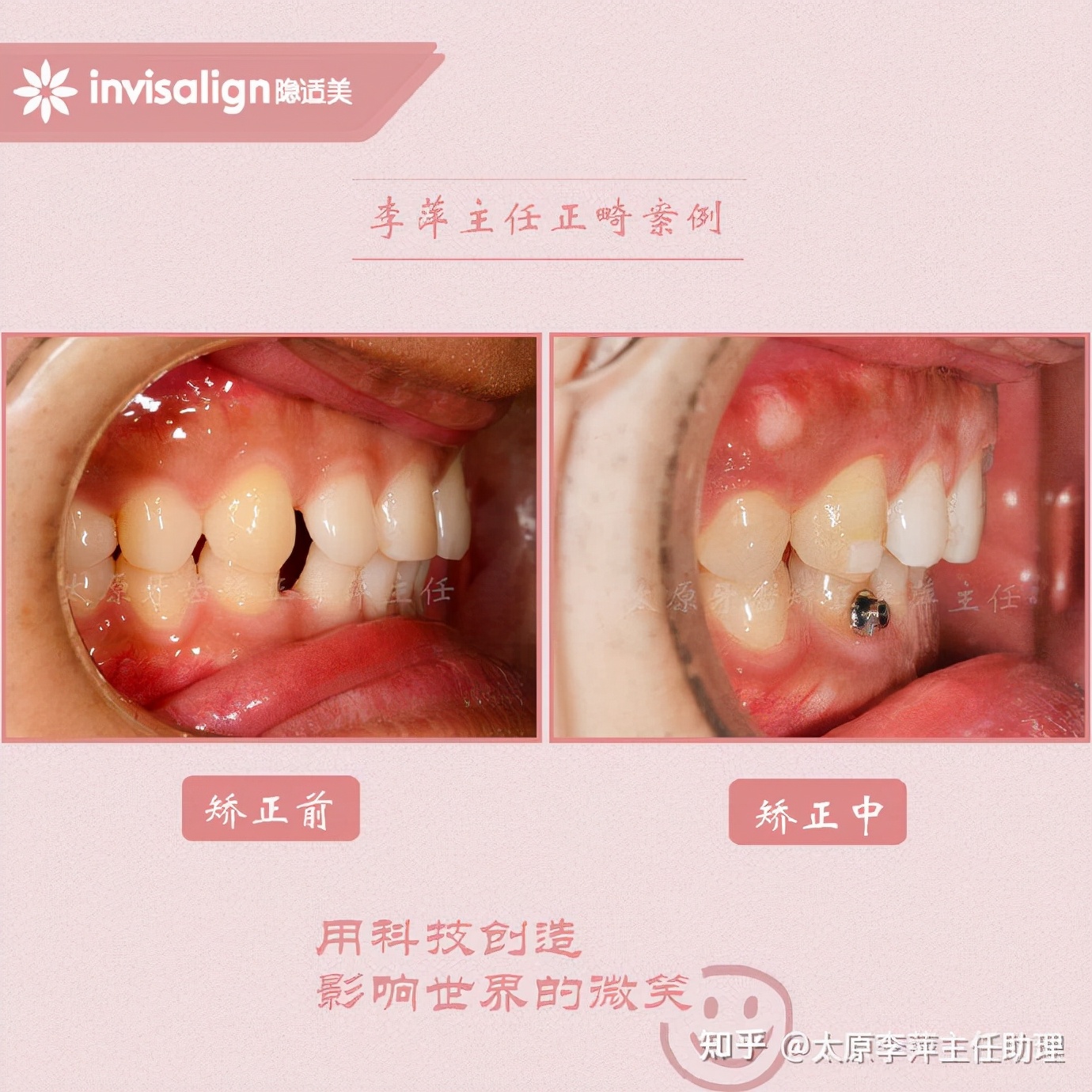 太原牙齿矫正靠谱吗,太原成人隐形牙套牙齿不齐