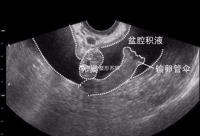 什么是盆腔积液？盆腔积液需要治疗么？一文解读误区