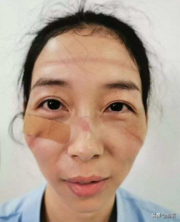 戴口罩久了皮肤屏障会受损吗,戴口罩戴久了鼻子不舒服