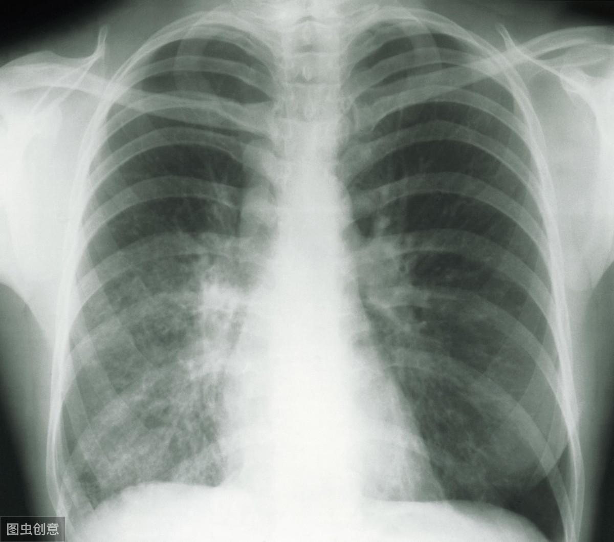 哪种肺结节最容易转癌,中医治小细胞肺癌比较可靠的方法