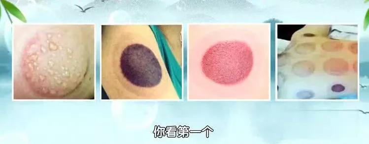 拔罐作用有那么大吗,拔罐的效果有多神奇