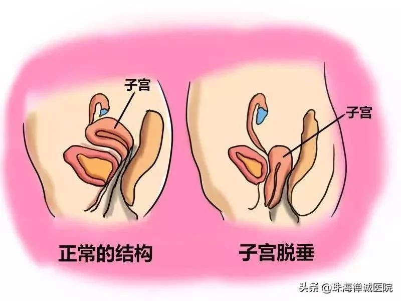 子宫脱垂困扰老年妇女如何治疗呢,老年女子宫脱垂