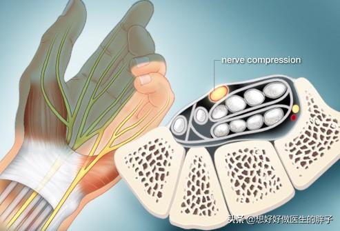颈椎痛手臂麻有几种治疗方法,颈椎病手麻按脖子的哪一根筋