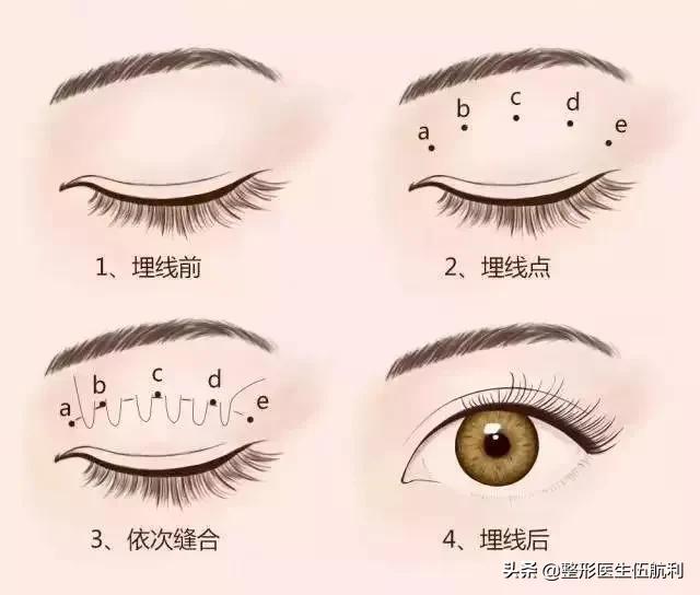 眼睛小应该做哪些眼综合手术,眼睛不对称怎么矫正医美