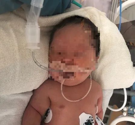 新生儿20天呼吸道感染症状及表现,新生儿宫内感染导致呼吸急促