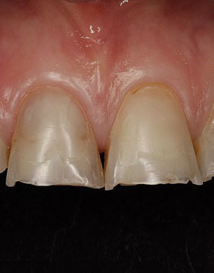 长期过度饮酒对牙齿的危害,长期吸烟喝酒的牙齿长什么样子