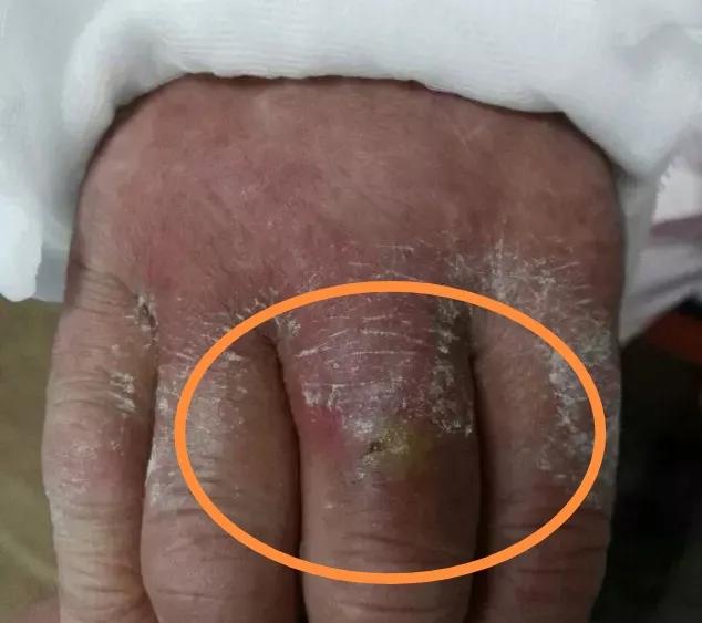 挤痘痘可引起败血症吗,挤痘痘引发的颅内感染能自己好吗