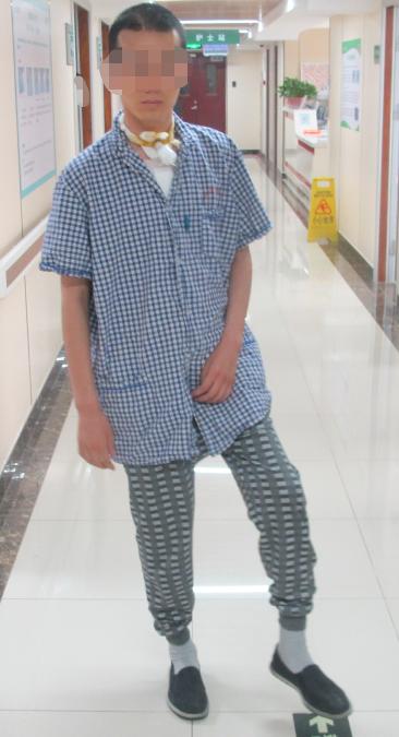 开颅手术后颅内细菌感染图片,外伤开颅手术后脑积液能恢复吗