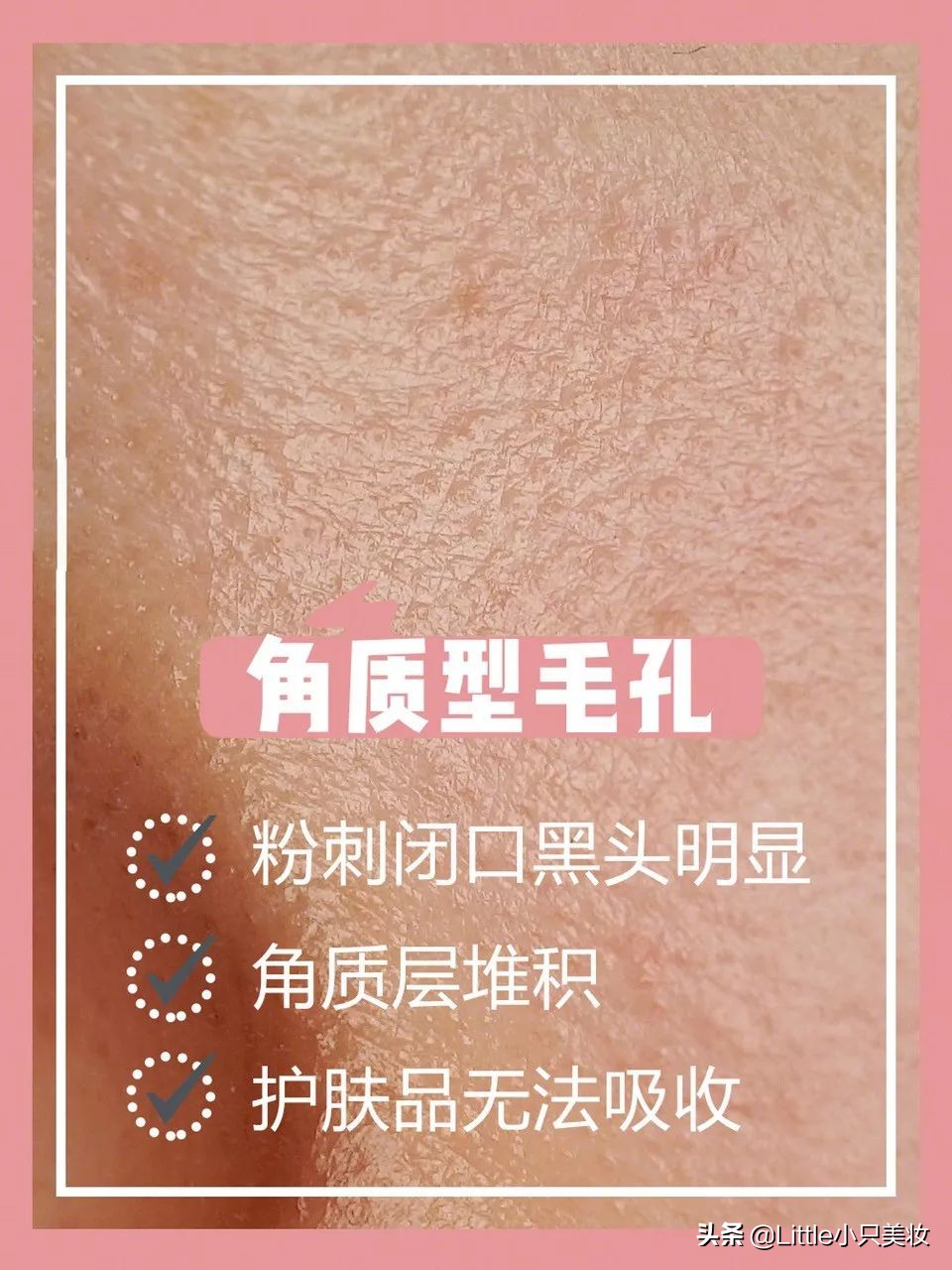 拯救小秘密,拯救毛孔粗大黑头粉刺