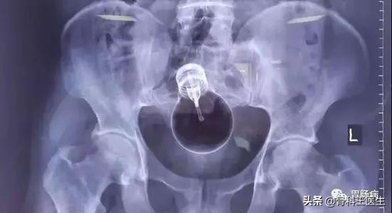 为什么会有人塞异物到直肠里,为什么会有人往尿道里塞异物