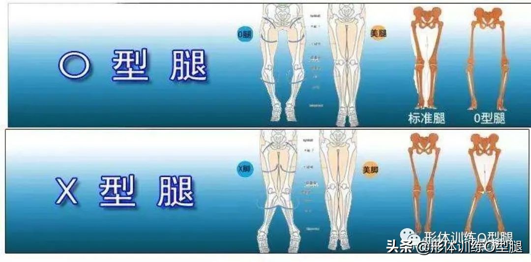 怎样矫正o型腿罗圈腿,罗圈腿和o型腿是怎么形成的