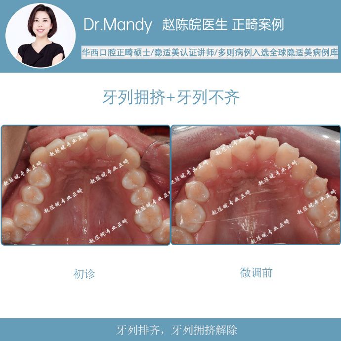 隐适美隐形矫正成功案例,经典隐形矫正