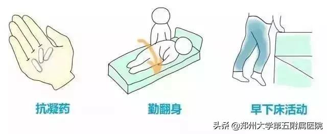 孕期如何预防深静脉血栓,妊娠期静脉血栓的高风险因素