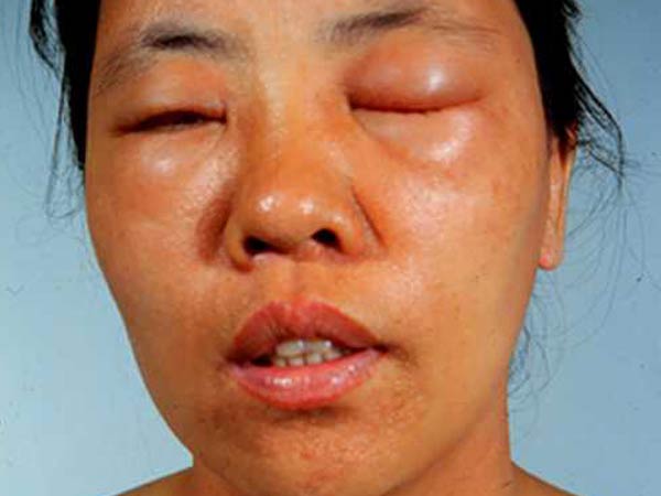 如何预防化妆品引发的皮肤病 (化妆品引起的皮肤病涂什么药好)