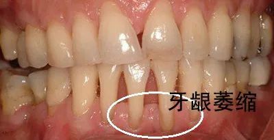 牙龈萎缩怎么办才能快速治愈,出现牙龈萎缩还可以矫正嘛