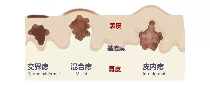 小心直径大于6毫米的痣