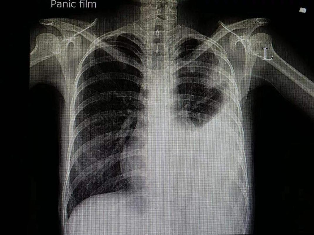 肺癌晚期有恶性胸腔积液,胸腔积液恶性是什么意思