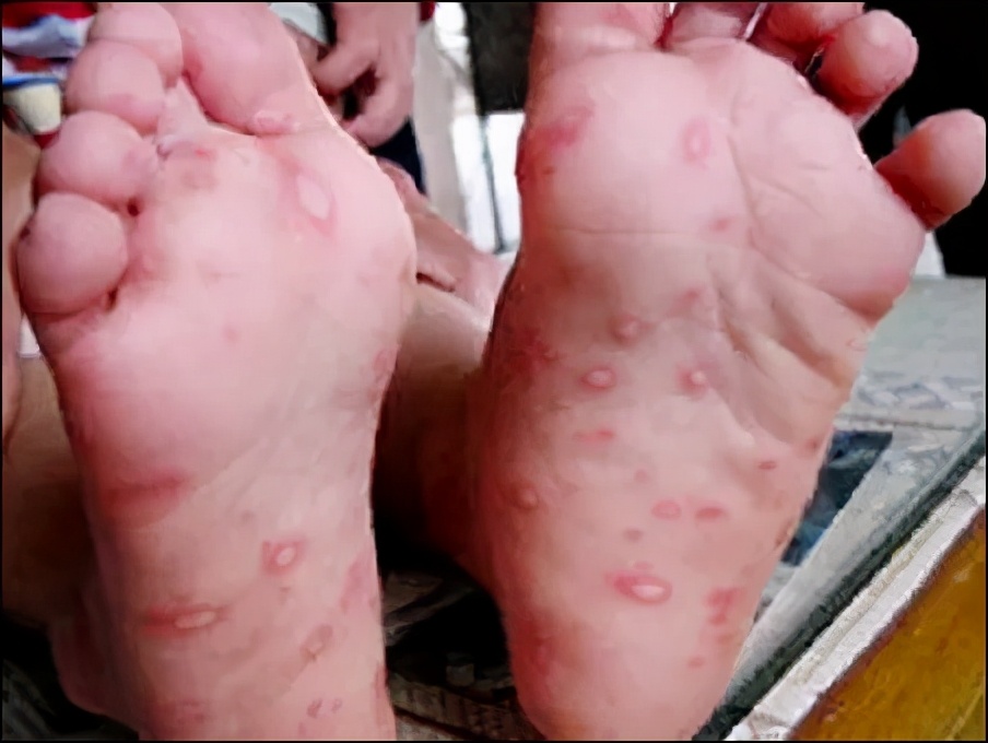 痒痒痒!身上出现这种小水疱,千万别戳破