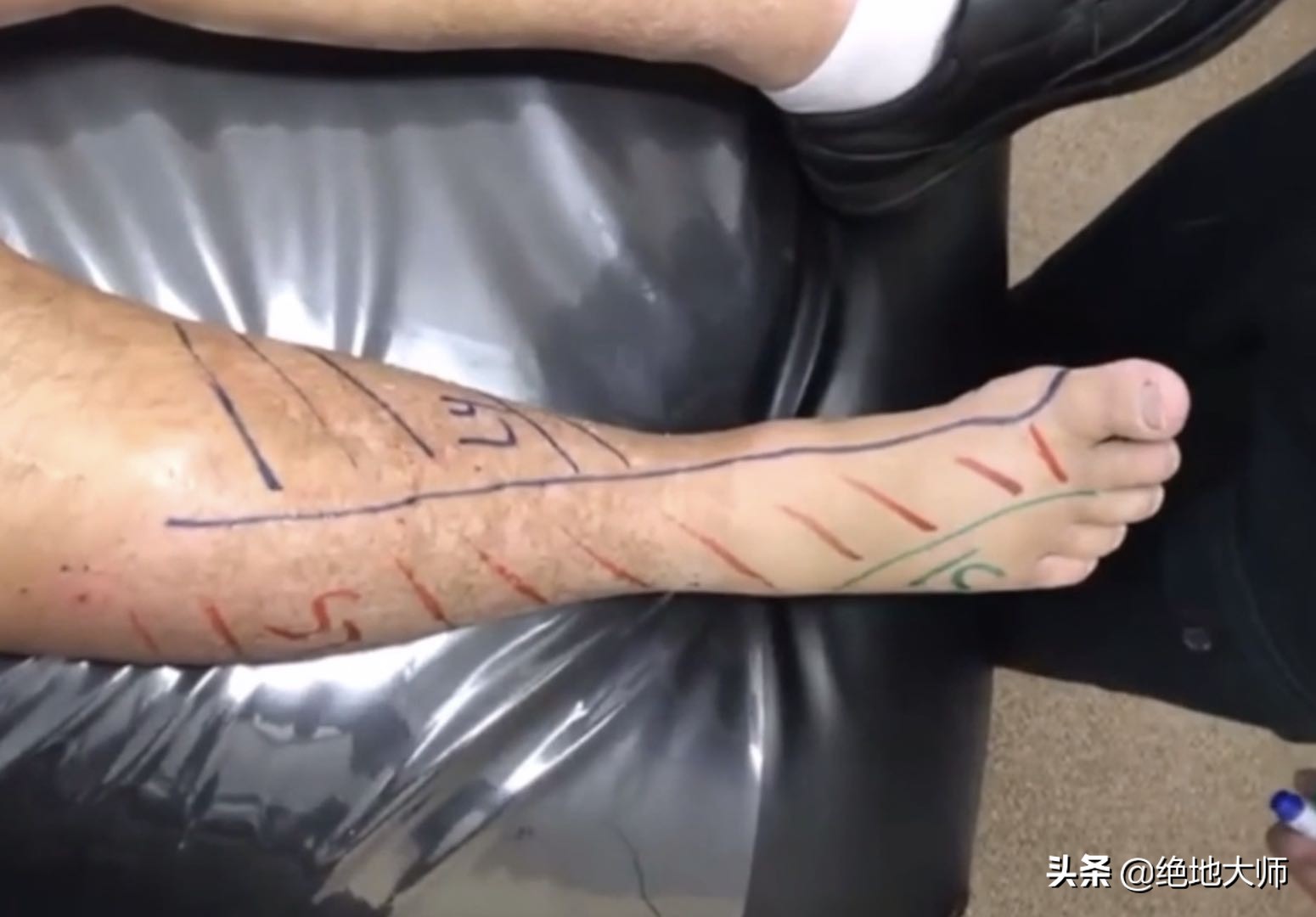 坐骨神经痛怎么治疗康复,坐骨神经疼吃哪种营养神经的药