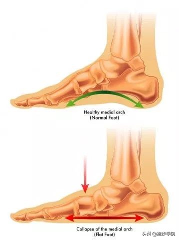 跑步怎样预防跟腱炎,预防跟腱炎最好的方法