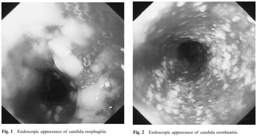 如何发现肺部真菌感染,怎样早期识别真菌感染