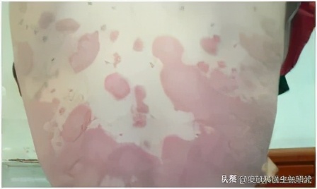 春节期间牛皮癣怎么治疗,牛皮癣冬季复发原因与调理