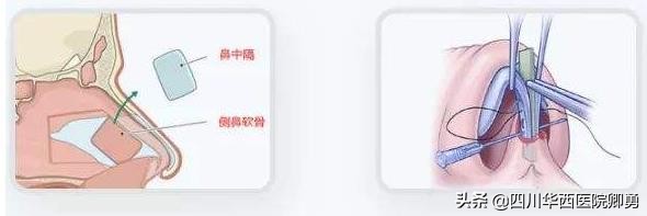 耳软骨加鼻中隔隆鼻价格多少,鼻中隔软骨隆鼻3d动画演示