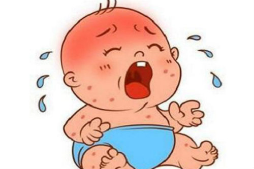 湿疹外用糖皮质激素,糖皮质激素能根除湿疹吗