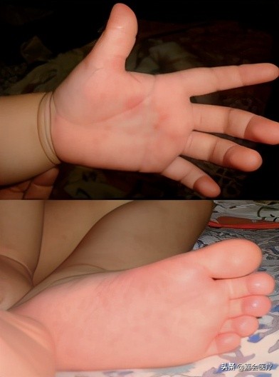 手足口病你必须知道,手足口病最新版知识解读