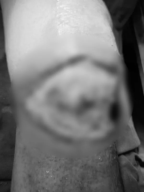 男士膝盖破了怎么办,膝关节破了个洞