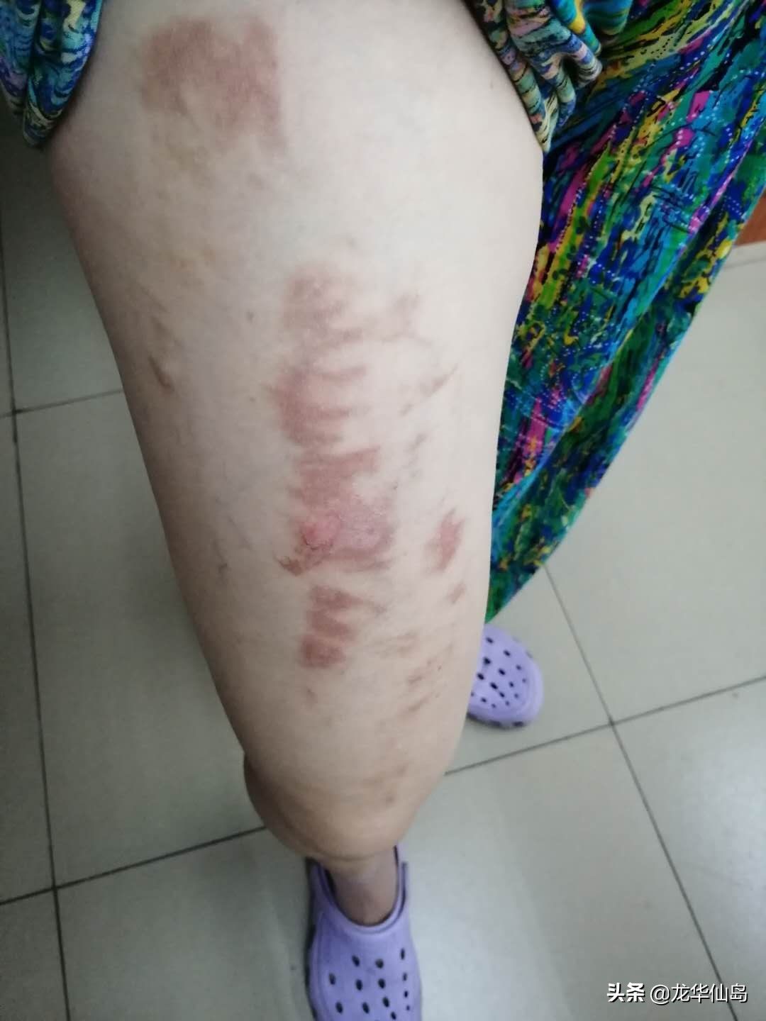 蟒蛇油使用案例与方法