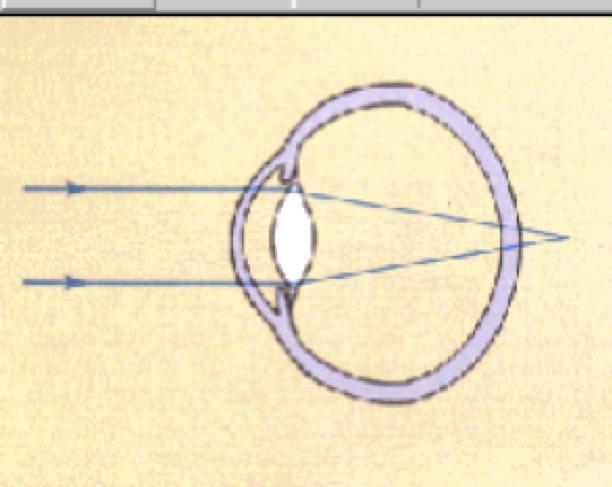 近视如何矫正能防止遗传,近视如何矫正视力下降