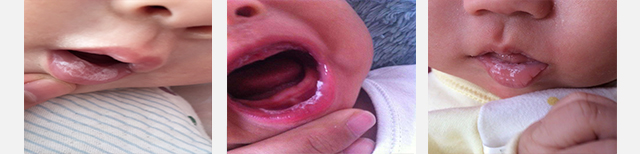 鹅口疮用了很多方法，反反复复怎么办？