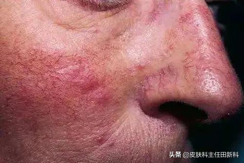 脸上痘印变成癣了怎么回事,痘印长癣