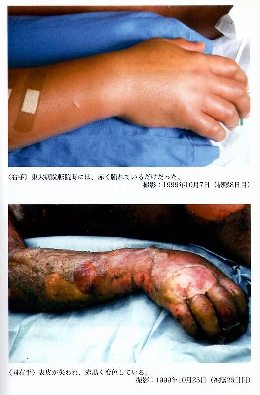 83天核事故救治纪录片,核灾83天死亡全记录