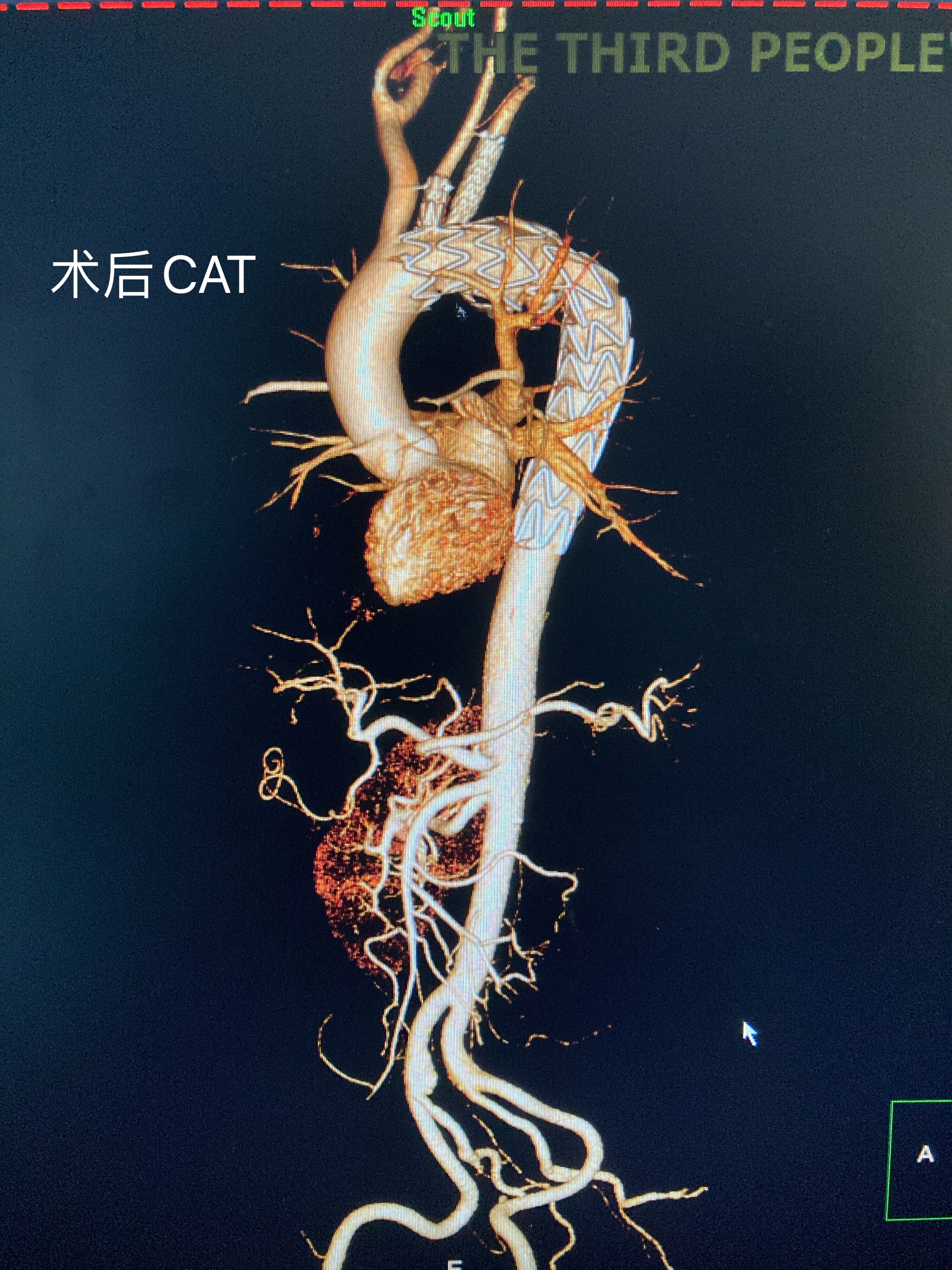 成都市第三人民医院一期工程,成都第三人民医院做心脏支架