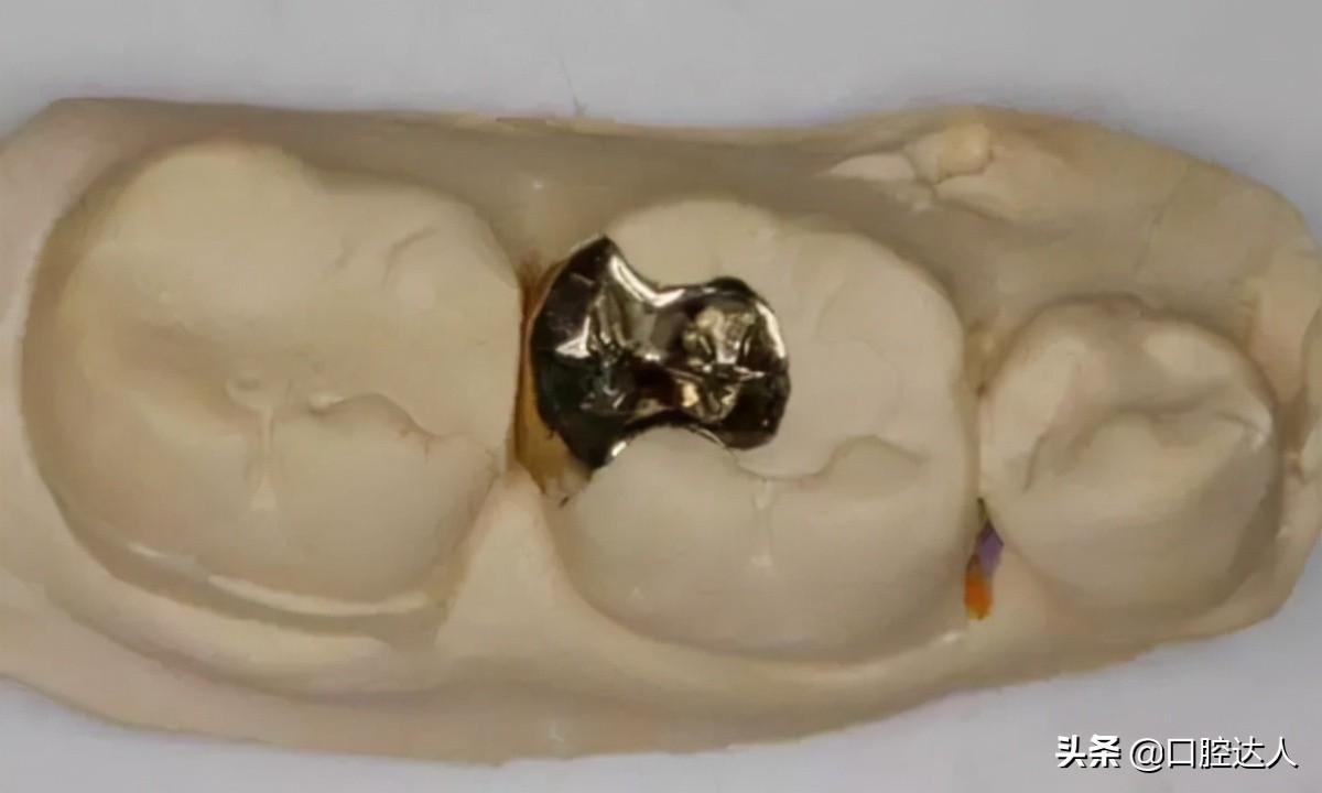 为什么补牙的东西会掉下来,补牙的材料为什么容易脱落