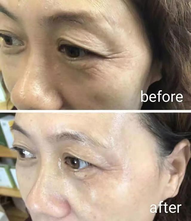 79岁英国一富婆为“除皱”，连打30年玻尿酸抗老，如今长啥样了？