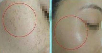 想要祛斑，先了解斑！有些斑连医美都治不好，你知道吗？