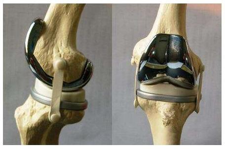 中医治疗类风湿性关节炎中成药,类风湿关节炎中医西医结合方案