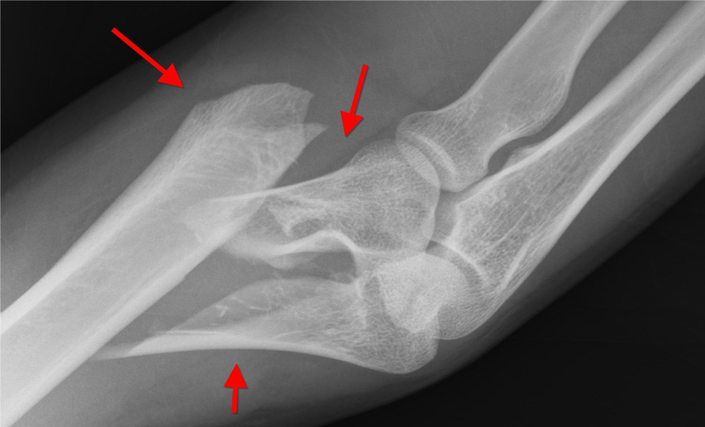 你知道伤筋动骨一百天，但不知道骨折要这样护理，恢复得又快又好