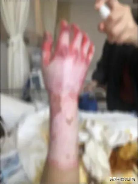 男子一边充电一边玩手机突然爆炸,男子边充电边玩手机发生爆炸