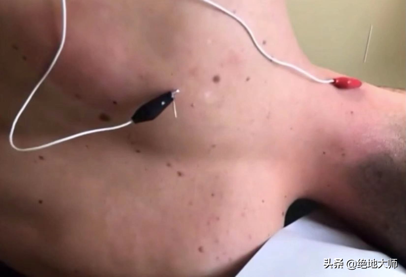 肩胛疼痛为何要做康复,肩胛区疼痛治疗