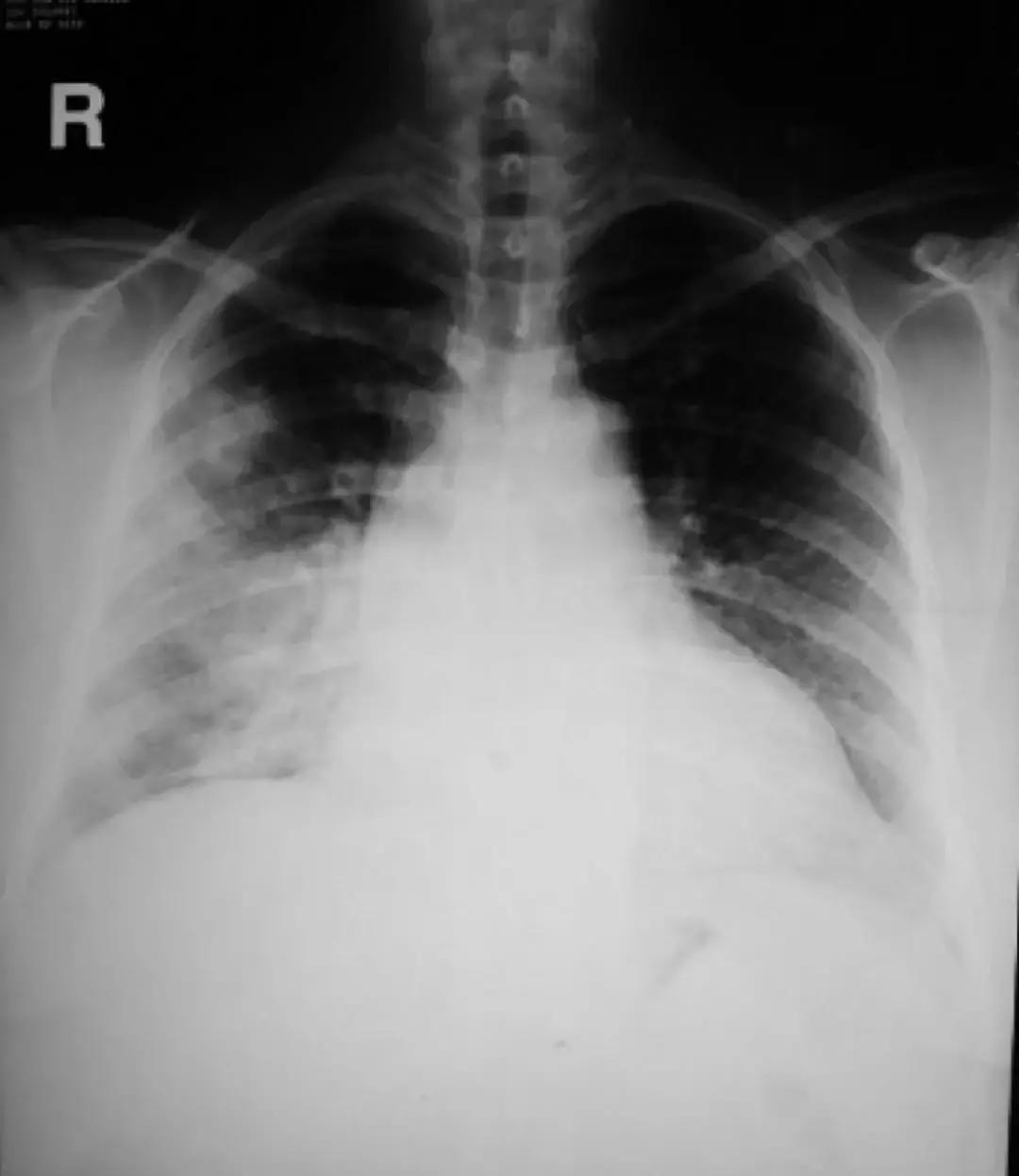 感染性疾病检测有问题,呼吸道感染诊疗指南